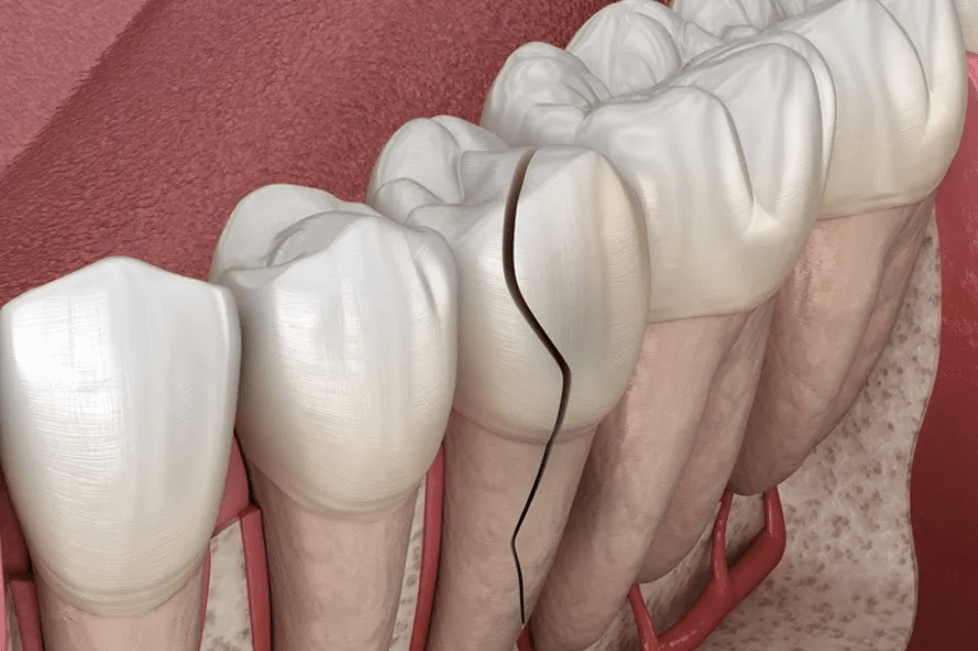 Crack Tooth Syndrome Atlas Dental Toronto Dentist