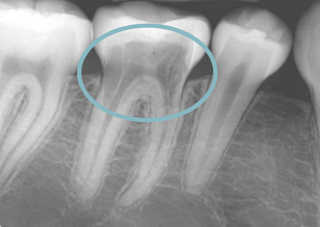 External Root Resorption Atlas Dental Toronto Dentist