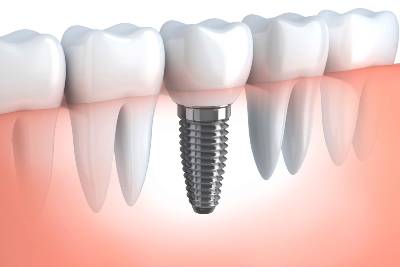 Dental Implants Atlas Dental Toronto Dentist