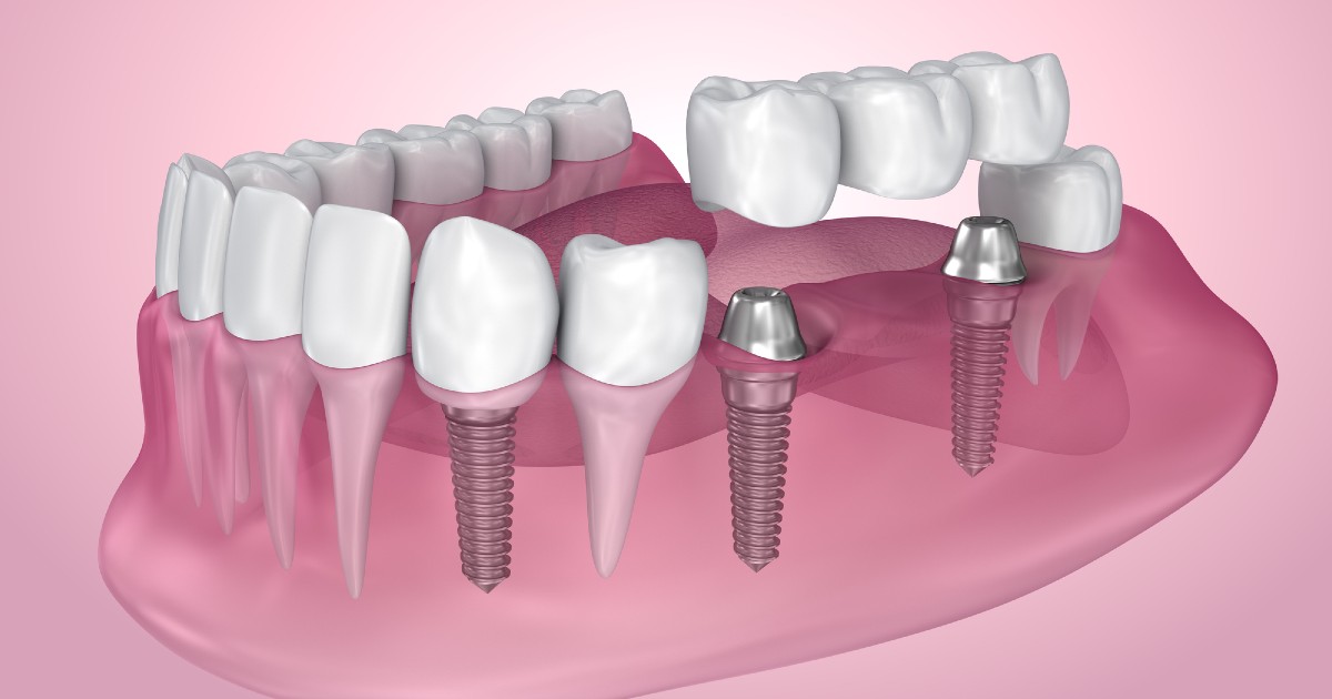 Post-Operative Instructions: Dental Implants at Columbia Basin Oral &  Maxillofacial Surgeons