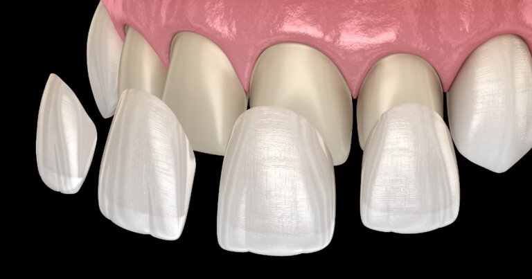 Lithium Disilicate Veneers- Atlas Dental, Toronto Dentist