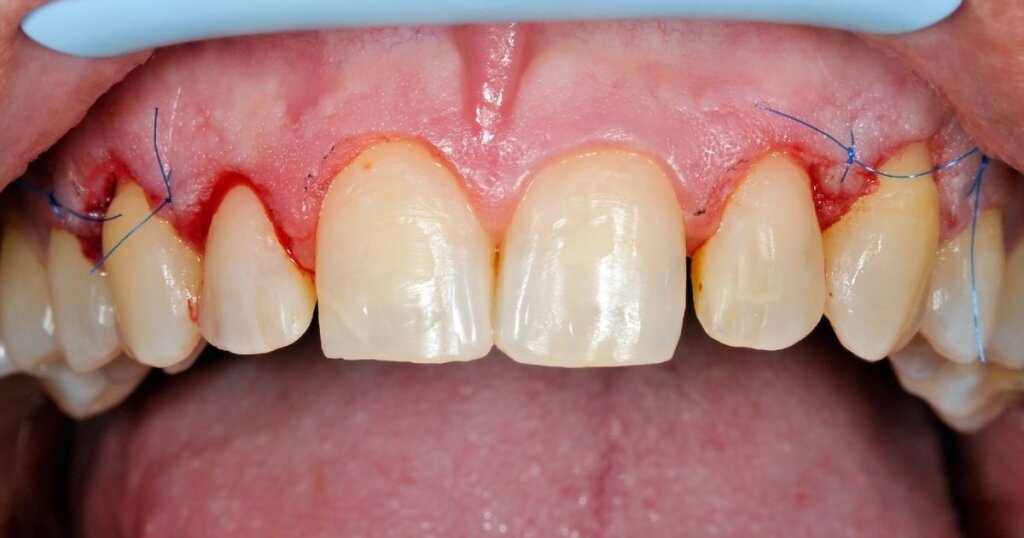 gum-graft-atlas-dental-toronto