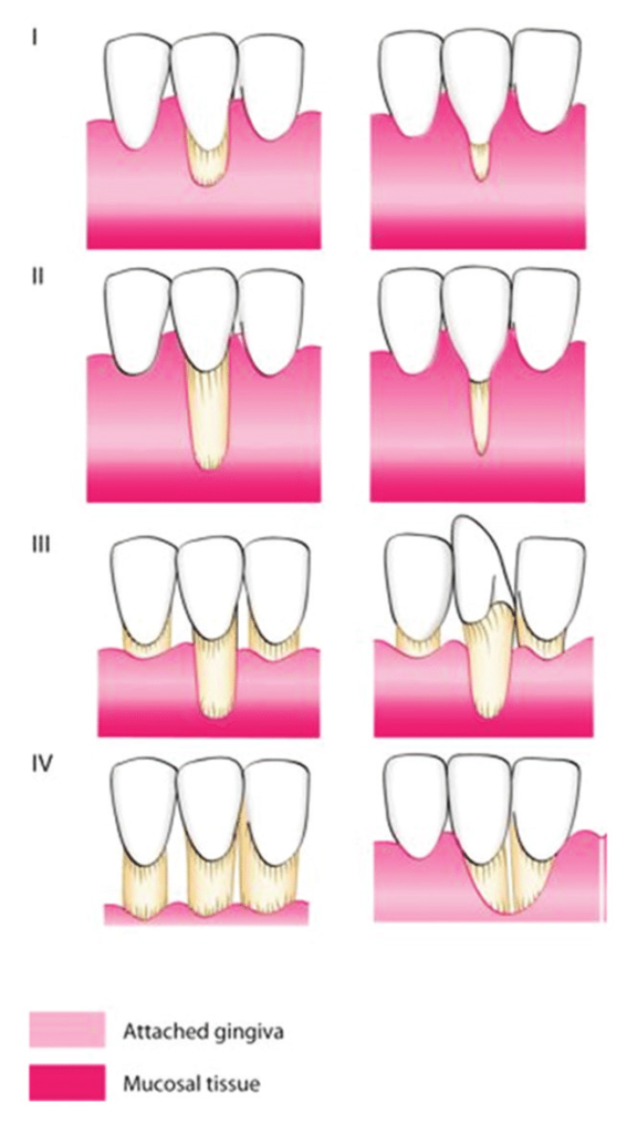 Gum Graft - Atlas Dental Toronto