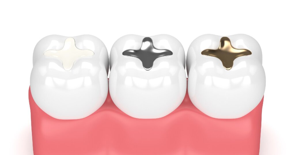 How much does a tooth filling cost? Atlas Dental
