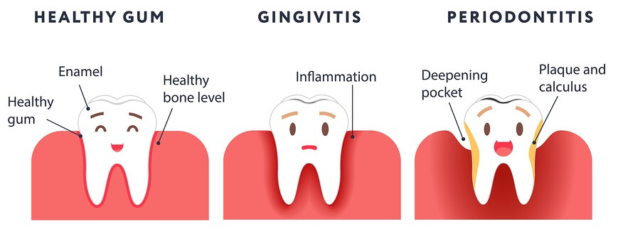 Gum Pain | Atlas Dental, Toronto Dentist