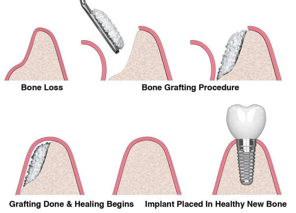 Dental Bone Graft Downtown Toronto Dentist