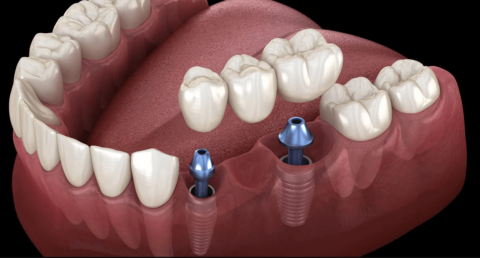 Dental Implant Bridge - Downtown Toronto Dentist