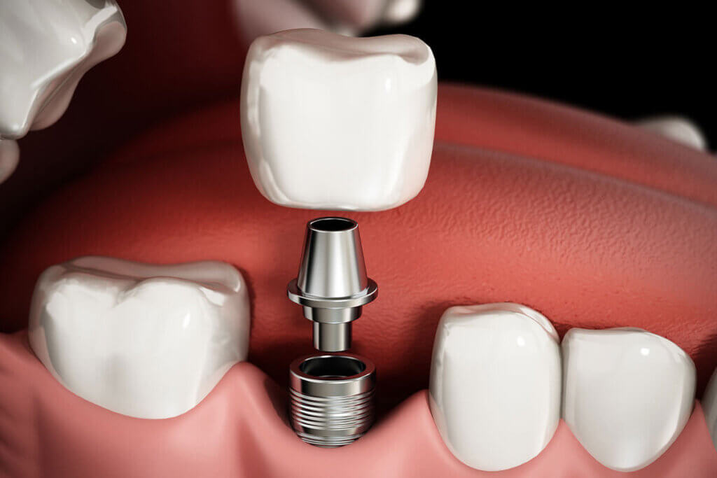 Dental Implant Crown - Downtown Toronto Dentist