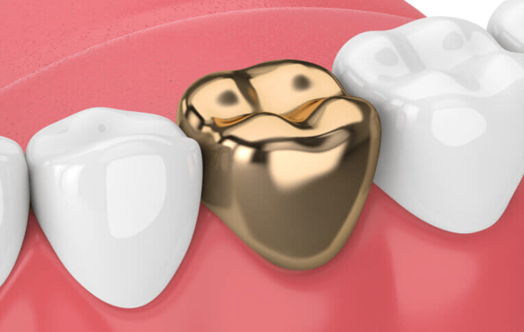 How Much Does A Dental Crown Cost? - Atlas Dental