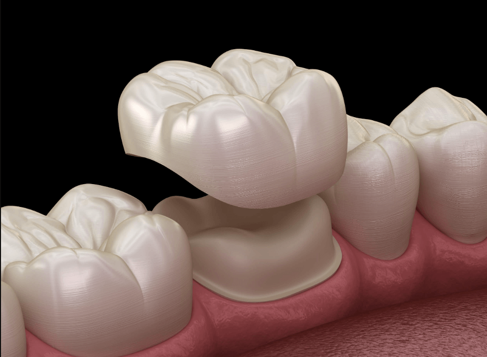 porcelain dental crown