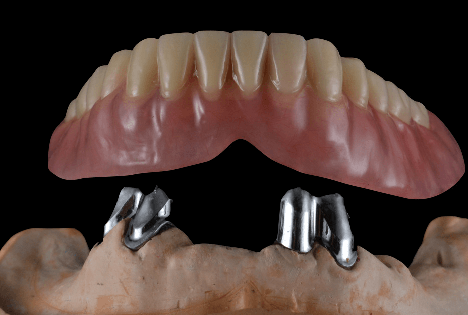 Tooth Supported Overdenture - Atlas Dental Toronto