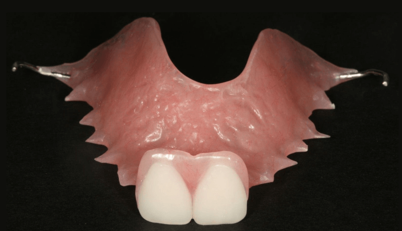 Single Tooth Denture - Atlas Dental Toronto