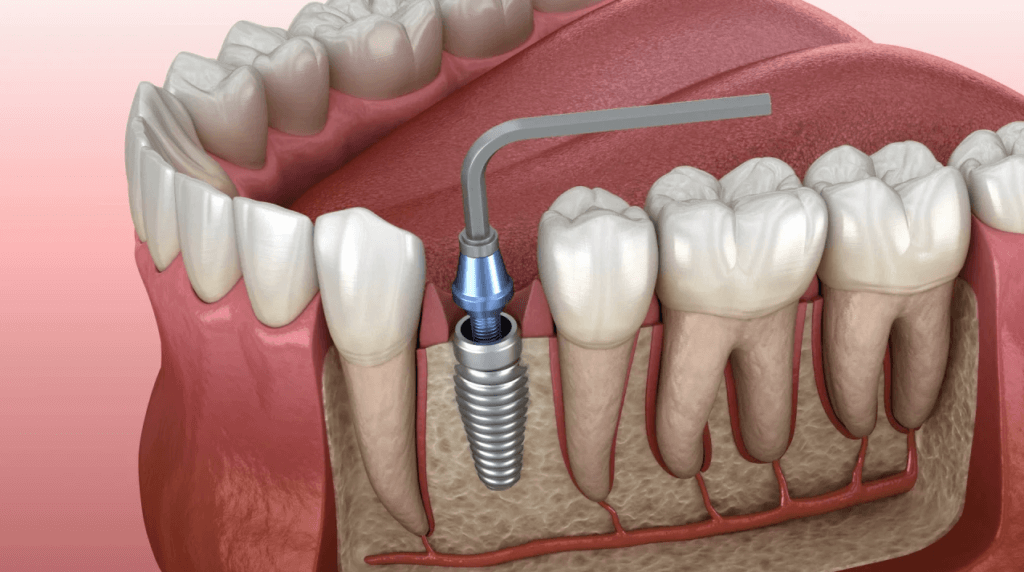 Immediate Dental Implant Placement Toronto Dentist