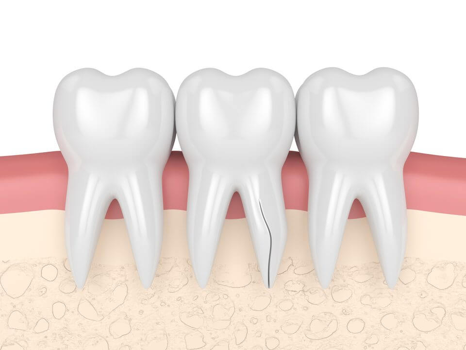 Vertical Root Fracture | Atlas Dental, Toronto Dentist