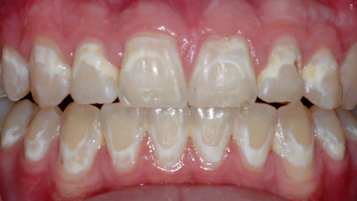 Icon Resin Infiltration - Atlas Dental