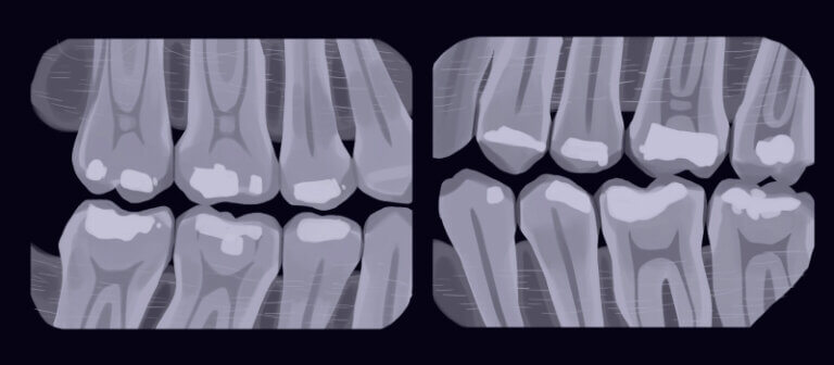 Bitewing xrays