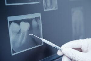 Periapical x-ray