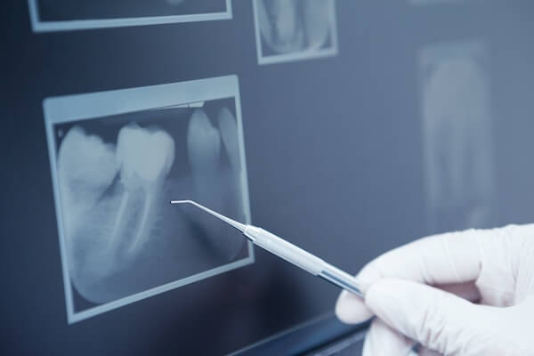 Periapical X-Rays - Atlas Dental Toronto