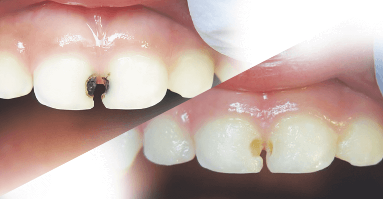 Teeth with silver diamine fluoride treatment stains