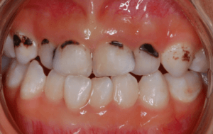 Teeth with silver diamine fluoride treatment stains