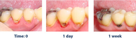 Teeth with silver diamine fluoride treatment stains