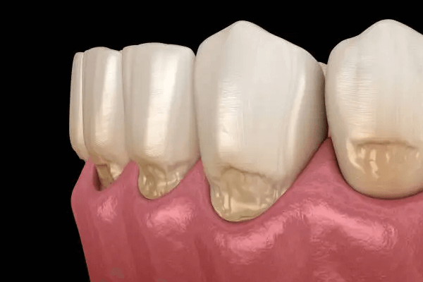 abfraction lesions