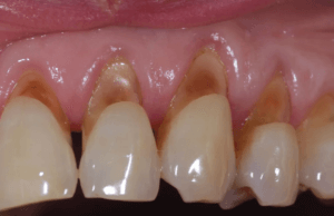 abfraction lesions