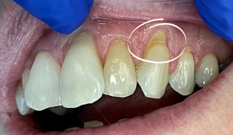 abfraction lesions