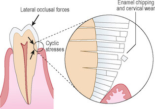 abfraction lesions