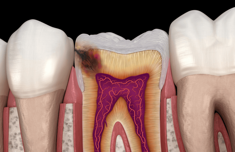 Interproximal cavity