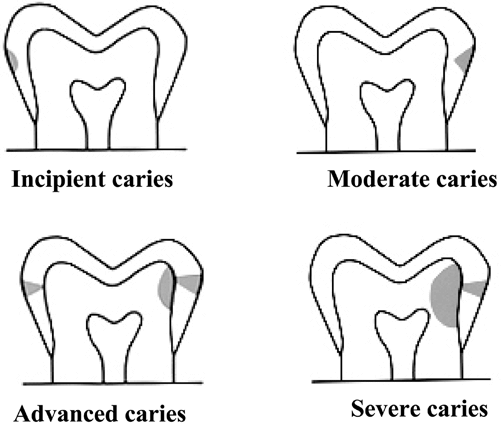 Interproximal cavity diagram