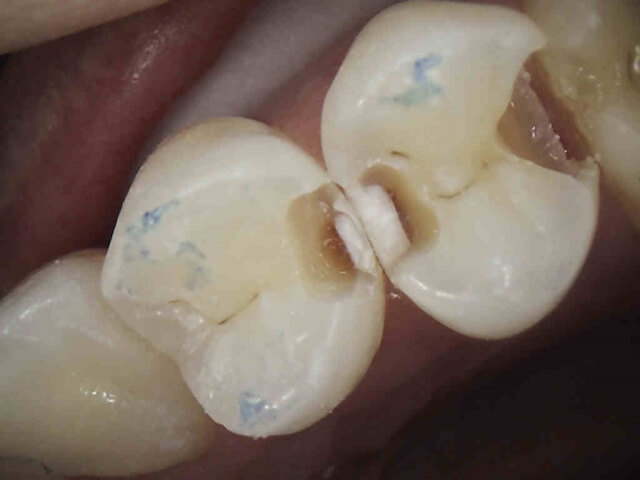 Interproximal cavity tooth preparation