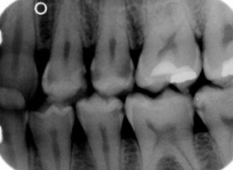 Interproximal cavity xray image