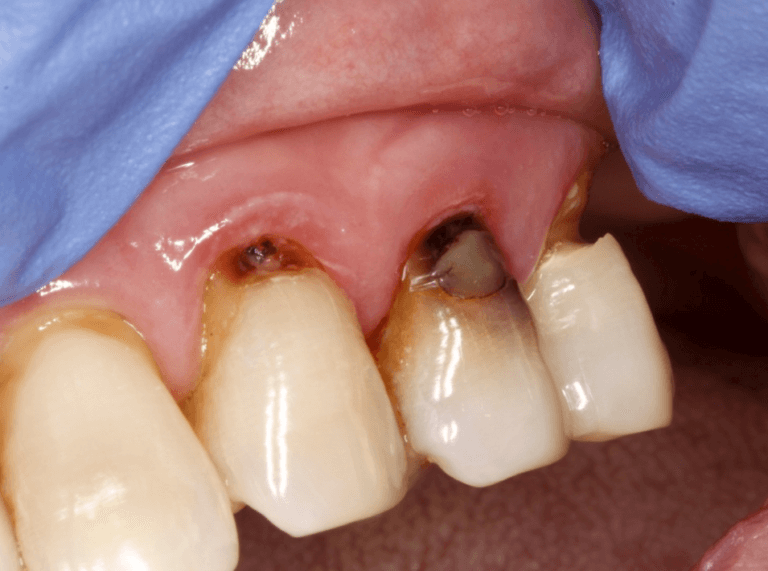 Root caries