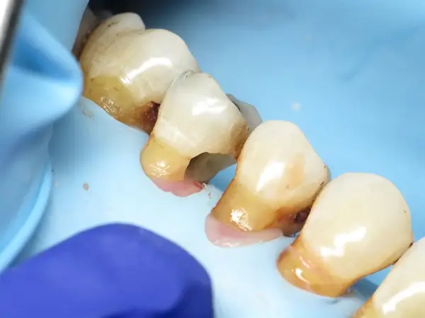 Root caries