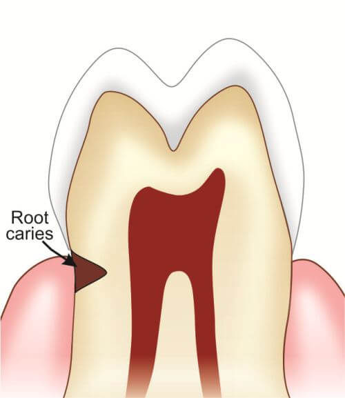 Root caries diagram