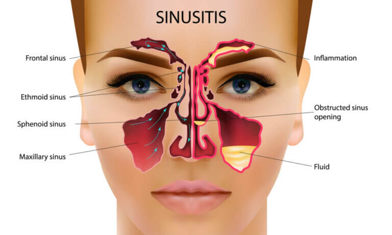 dental inflammation of the sinuses