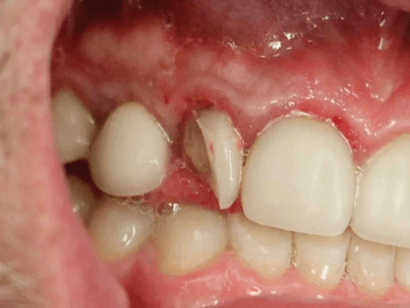 Chipped dental crown