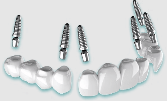 3 On 6 Dental Implants Toronto