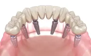 3 On 6 Dental Implants Toronto