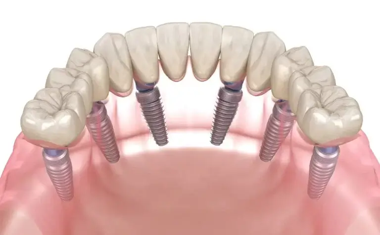 3 On 6 Dental Implants Toronto