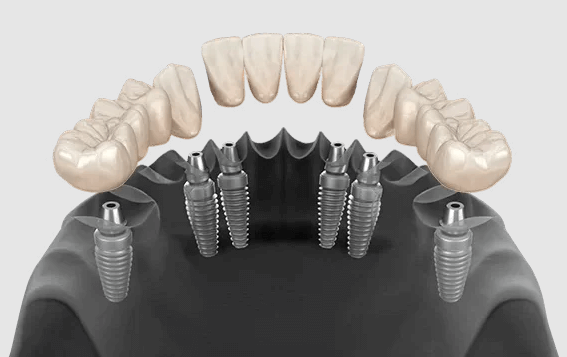 3 On 6 Dental Implants Toronto