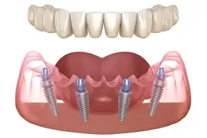 All-on-4 Dental Implants Toronto