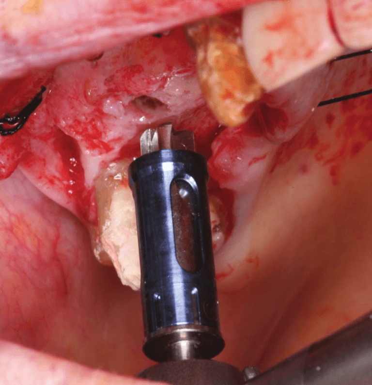 Hiossen crestal approach sinus lift surgery Toronto