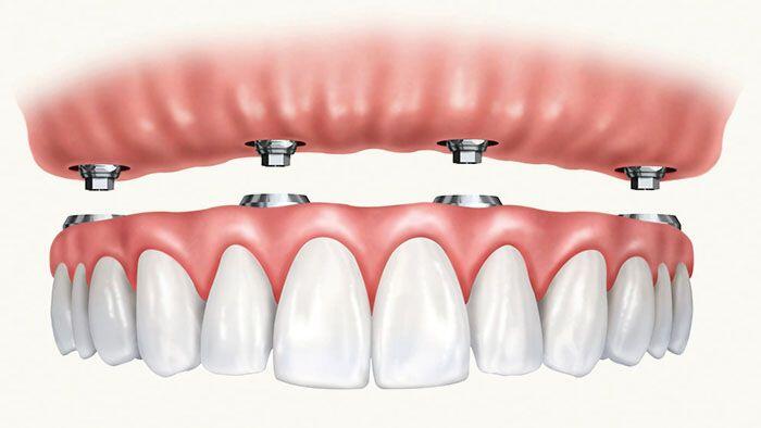 All-on-4 Dental Implants Toronto