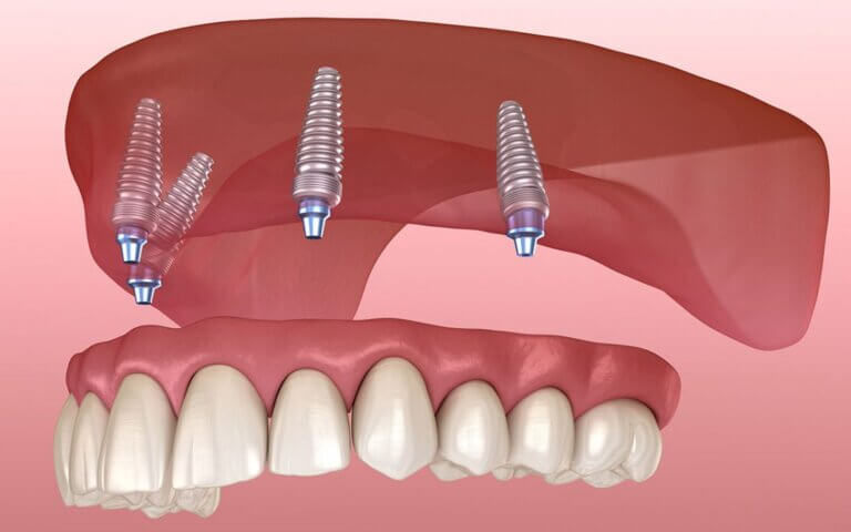 All-on-4 Dental Implants Toronto