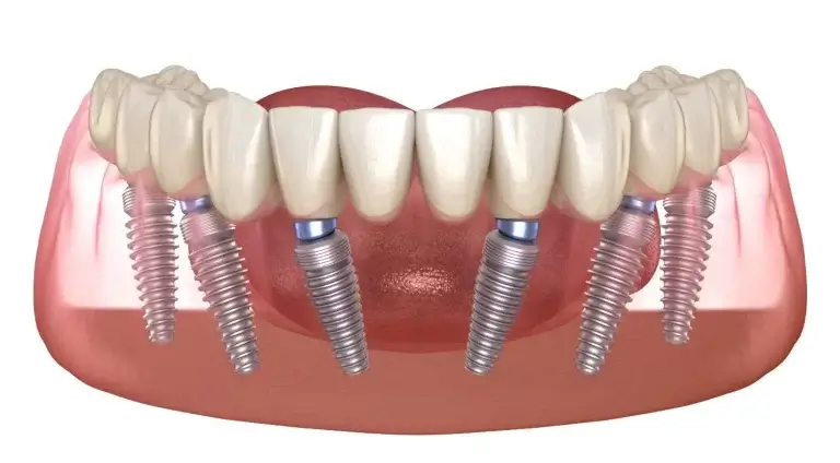 All-on-6 dental implants Toronto