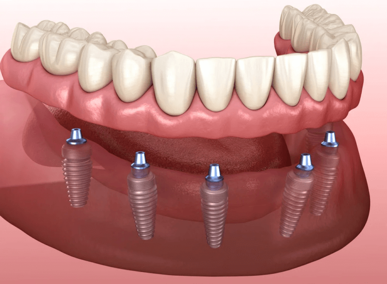 All-on-6 dental implants Toronto