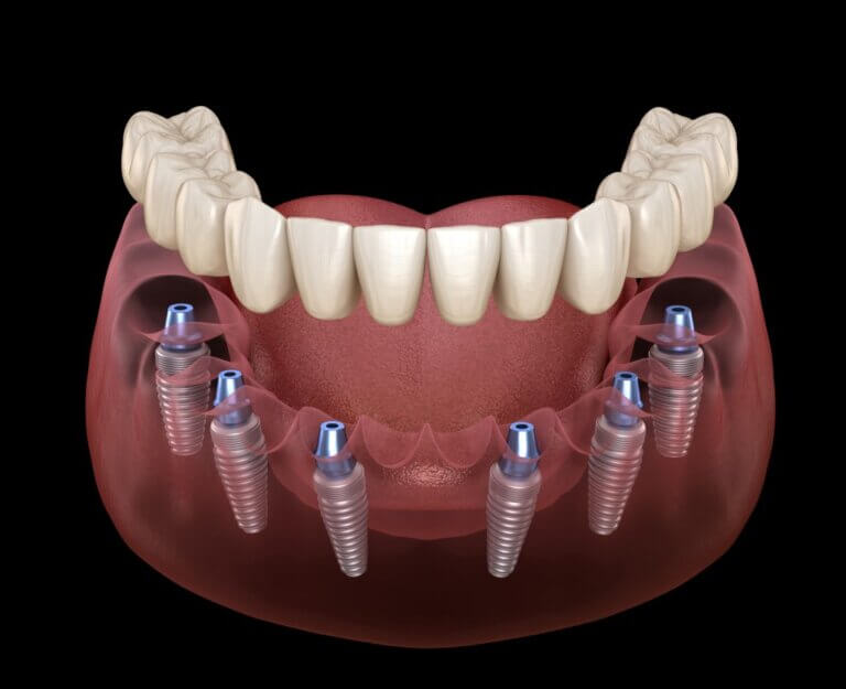 All-on-6 dental implants Toronto