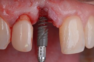 Dental implant removal Toronto